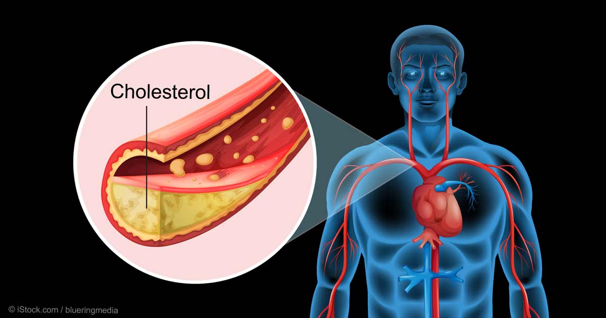 hypercholesterolemia