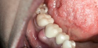 home remedies for tooth infection