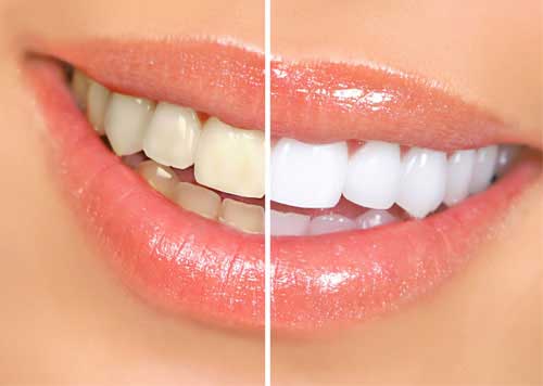teeth whitening Toronto
